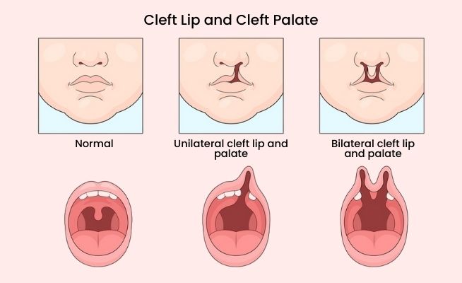 Cleft Lip And Palate Surgery In Nagpur 