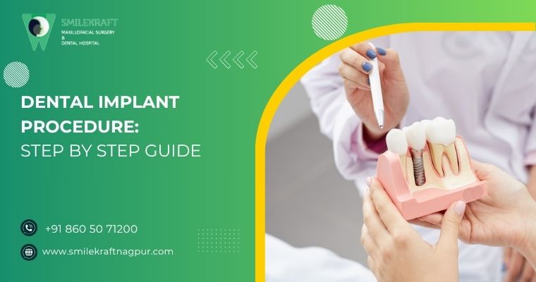 Dental Implant Procedure: Step-By-Step Guide 