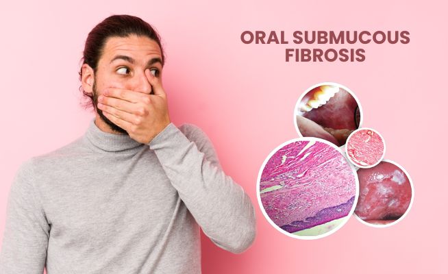 oral submucous fibrosis treatment in Nagpur oral submucous fibrosis treatment in Nagpur