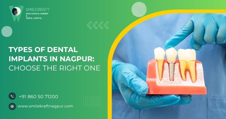 Types of Dental Implants in Nagpur: Choose the Right One 