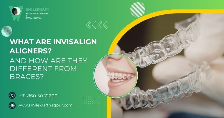 what are invisalign aligners? and how are they different from braces?